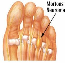 Morton's Neuroma