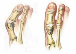 bunion surgery recovery