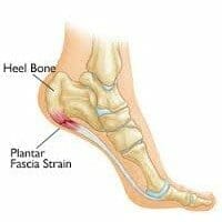 Top Plantar Fasciitis Home Remedies