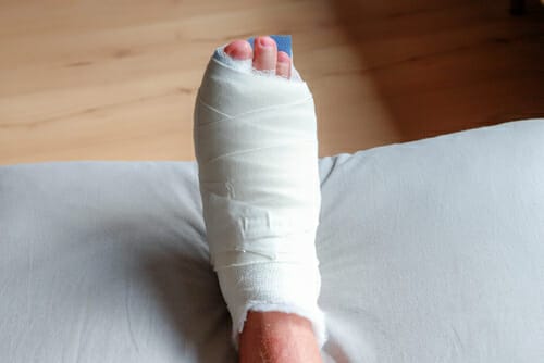 Cast after a bunion surgery 