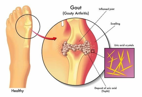 gout Big toe joint pain