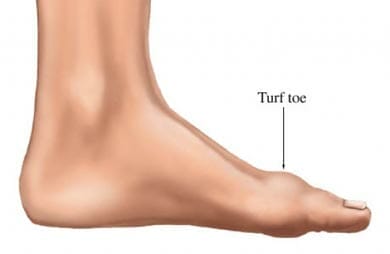 turf toe big toe joint pain
