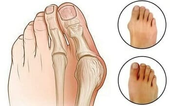Before-and-after-bunion-brace