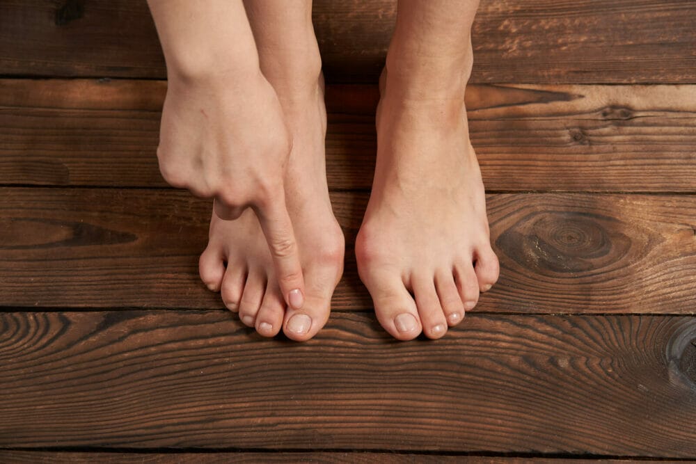 Treat Bunions Without Surgery