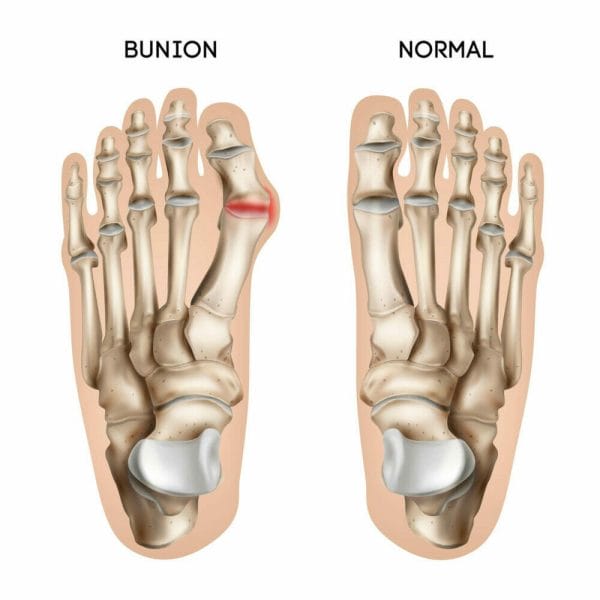 Illustration of normal and bunion-damaged foot