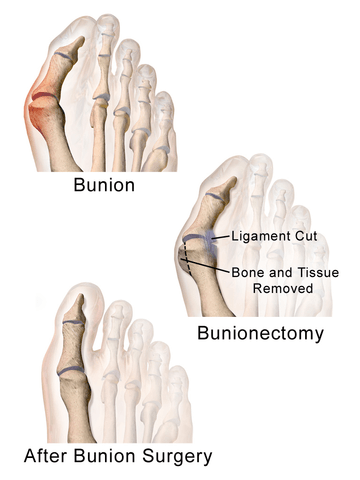 Bunionectomy-before and after-bunion-surgery